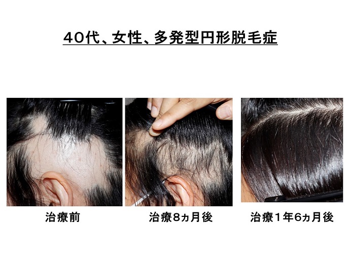 円形脱毛症　病院